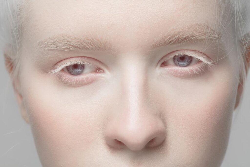 Albinism ocular_ce reprezintă această afecțiune_fata, ochi, nas