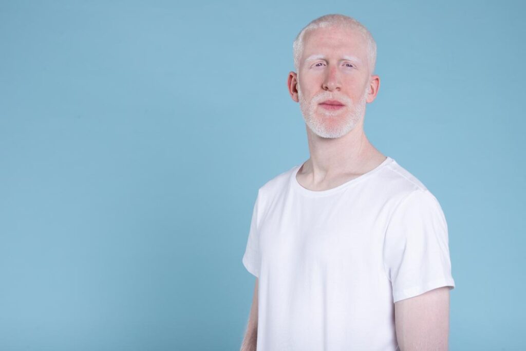 Tipuri de albinism_care sunt caracteristicile distincte ale fiecărui tip_barbat, tricou alb, fundal albastru