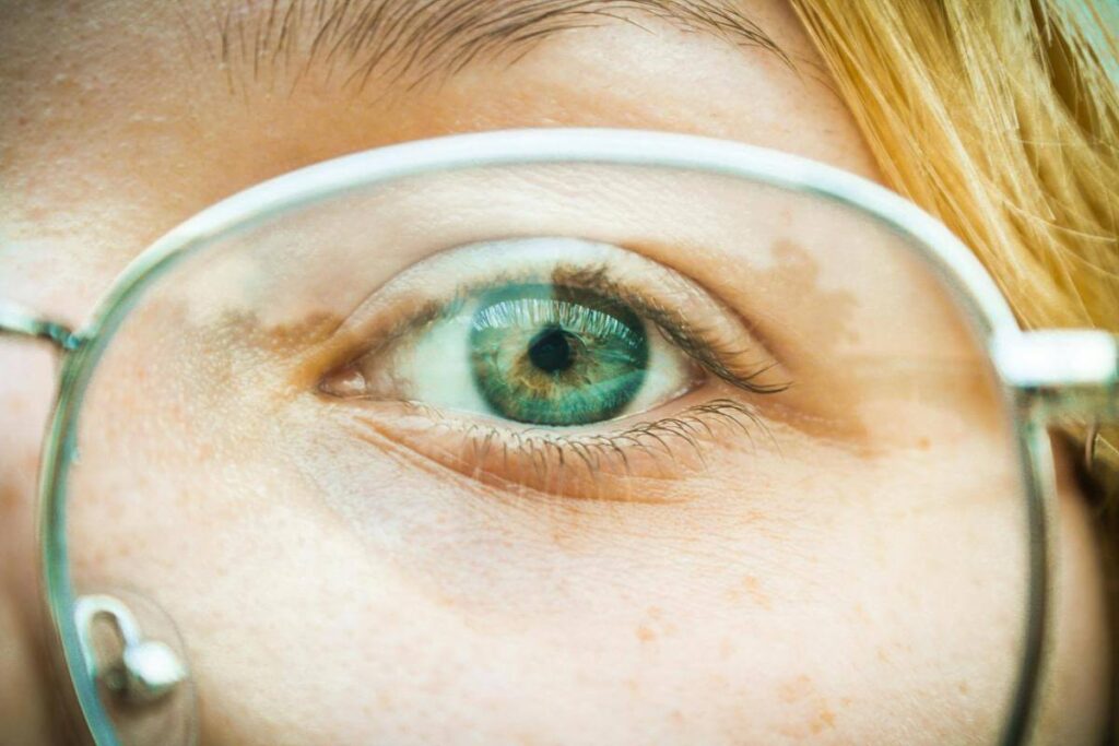 Astigmatism si miopie-pupila, lentila de ochelari de vedere